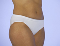 c-panty after cesarean underwear